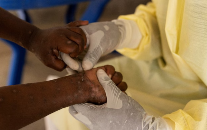 WHO declares Mpox global health emergency amid rising death toll in Africa